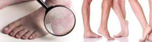 Народные средства от экземы на ногах: лечение в домашних условиях сухой и мокрой патологии