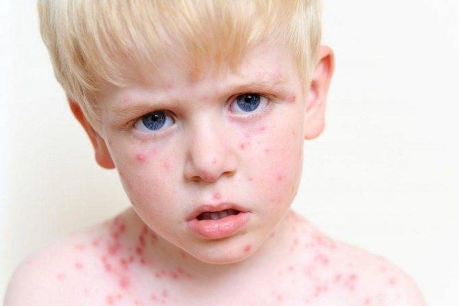 Болезнь пузырчатка: симптомы, фото, лечение у детей и взрослых