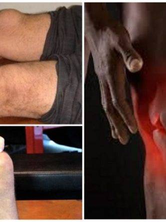 Методы лечения инфрапателлярного бурсита коленного сустава