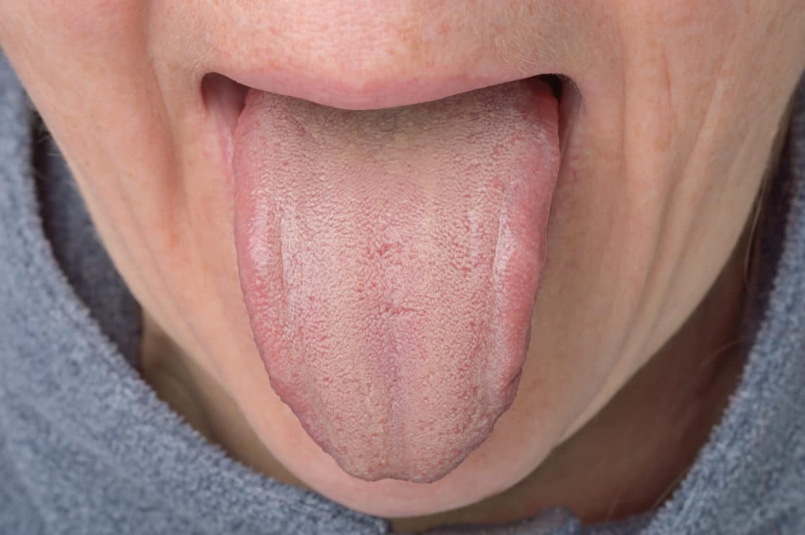 Как выглядит язык при гастрите и почему ком в горле