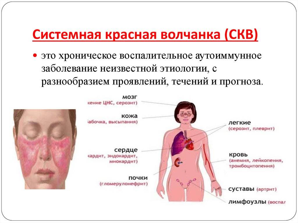 Вич носа. Системная красная волчанка кожные симптомы. Наиболее характерные симптомы системной красной волчанки. Системная красная волчанка это аутоиммунное заболевание. Сыпь при системной красной волчанке.