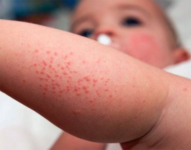Может ли крапивница быть на нервной почве у ребенка | неталлергии!