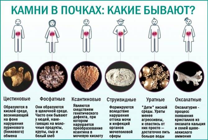 Камни в мочевом пузыре у женщин и мужчин: симптомы, признаки и удаление камней