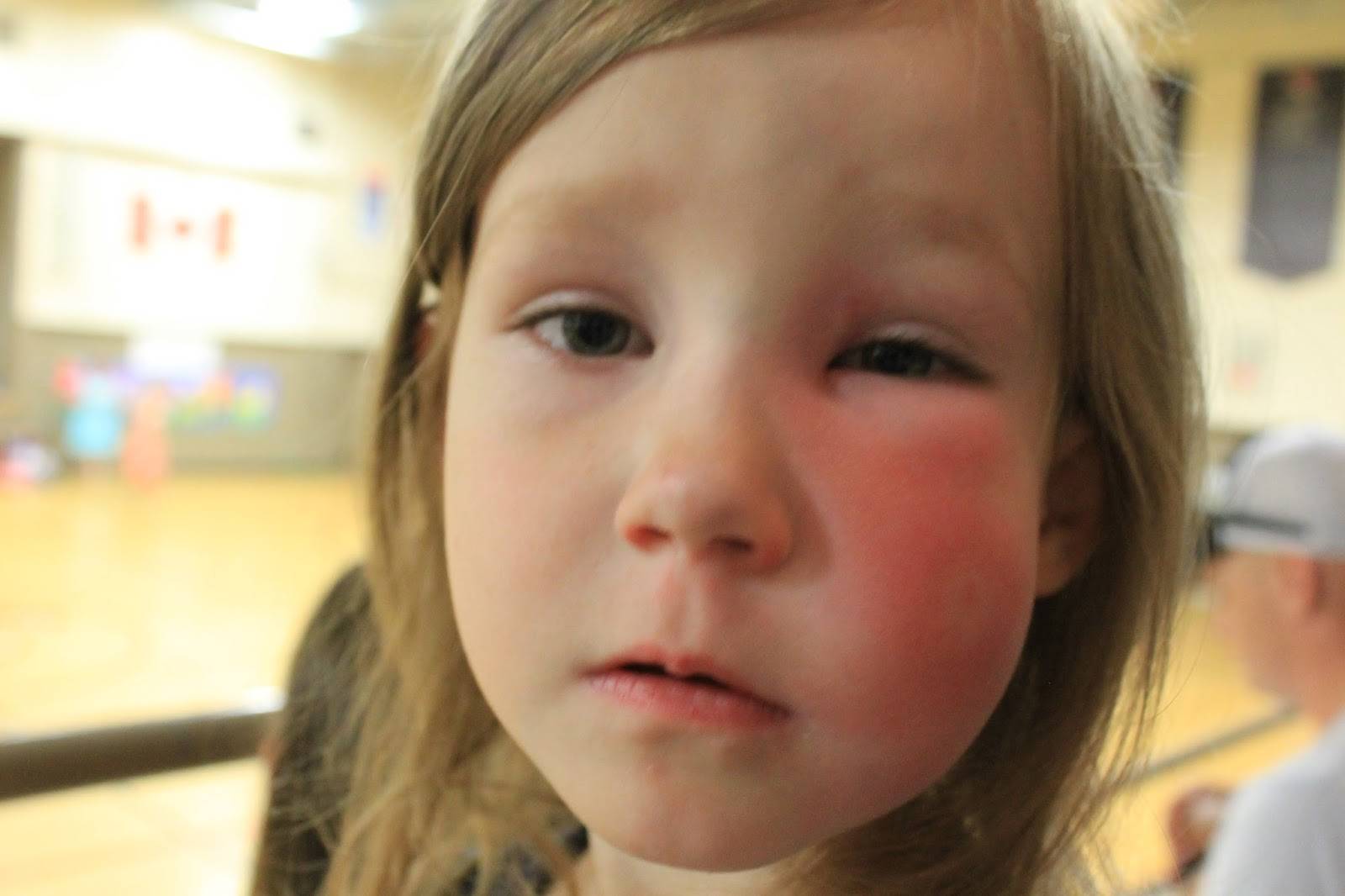 Отёк квинке на лице лечение • аллергия и аллергические реакции