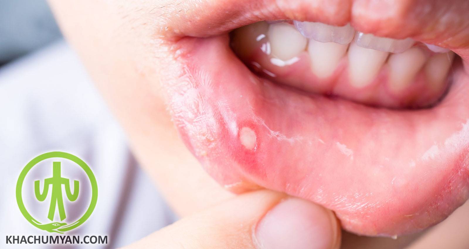 Герпес во рту у взрослых: лечение, как выглядит (фото), причины