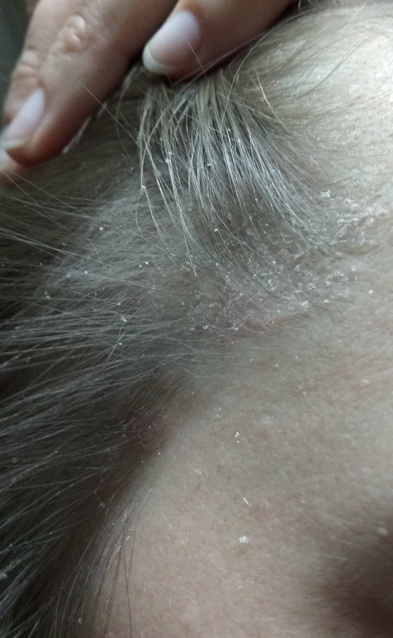Сыпь на шее: фото, возможные болезни, лечение | заболевания кожи