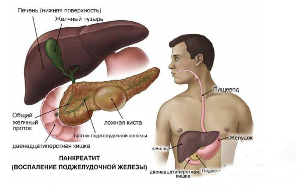 Хронический панкреатит поджелудочной железы, симптомы и лечение