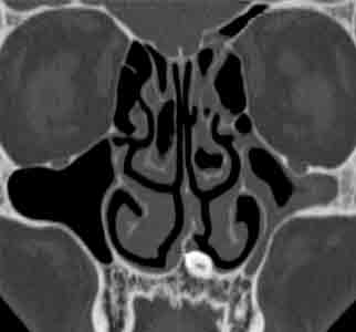 Что показывает, как делают и как проводится компьютерная томография пазух носа?