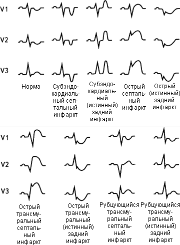 Признаки на экг инфаркта миокарда