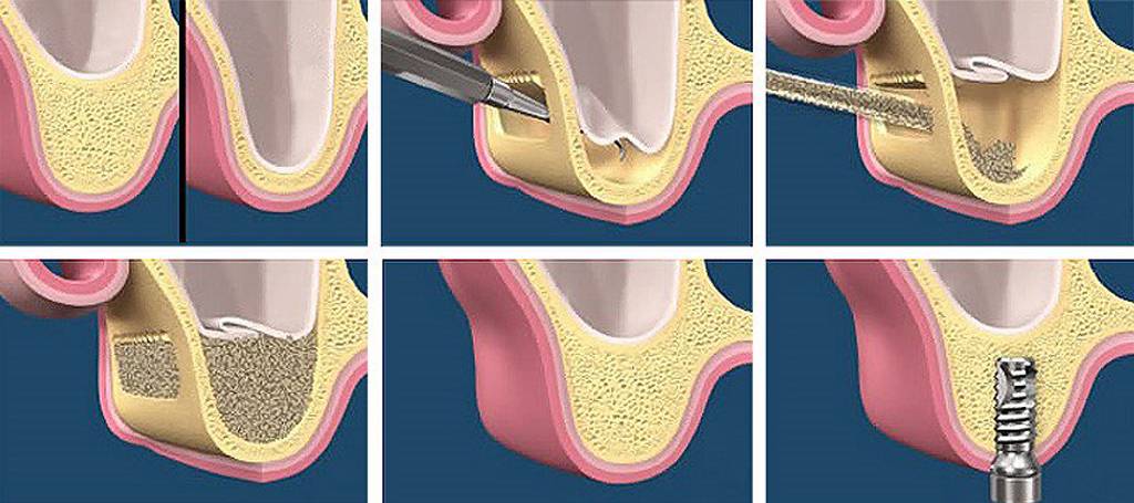 Синус-лифтинг в стоматологии и его осложнения: открытый и закрытый, фото