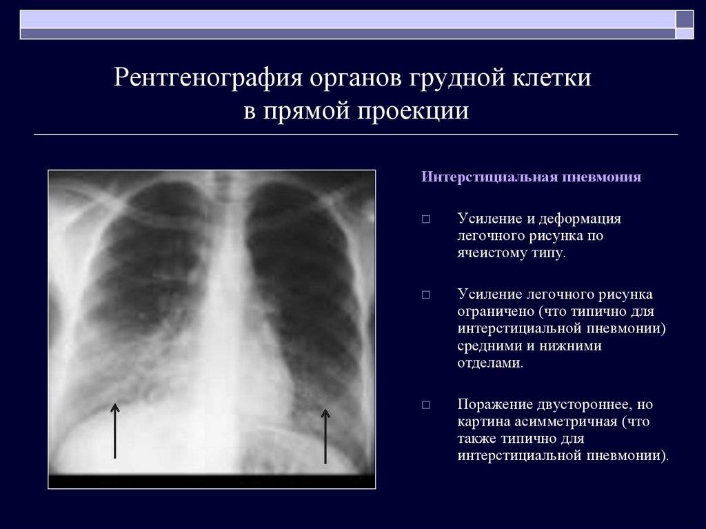 Усилен отделах легких. Рентгенограммы органов грудной клетки пневмония. Рентгенологическая картина при интерстициальной пневмонии. Паренхиматозная пневмония рентген. Интерстициальная пневмония рентген.