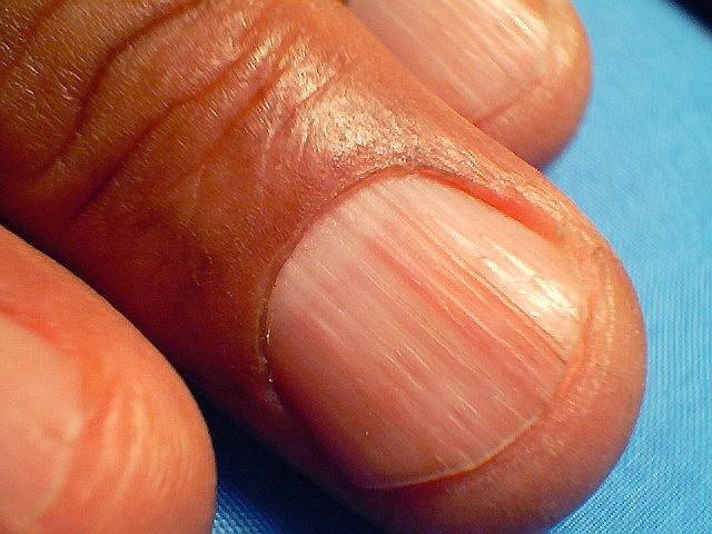 Продольные полосы на ногтях рук: причины и лечение, профилактические мероприятия, уход