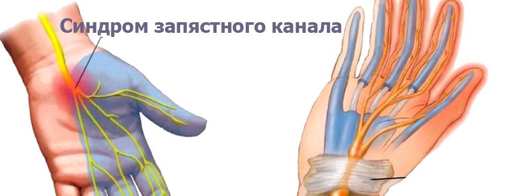 Туннельный синдром запястья кисти руки: симптомы, причины развития, лечение, профилактика