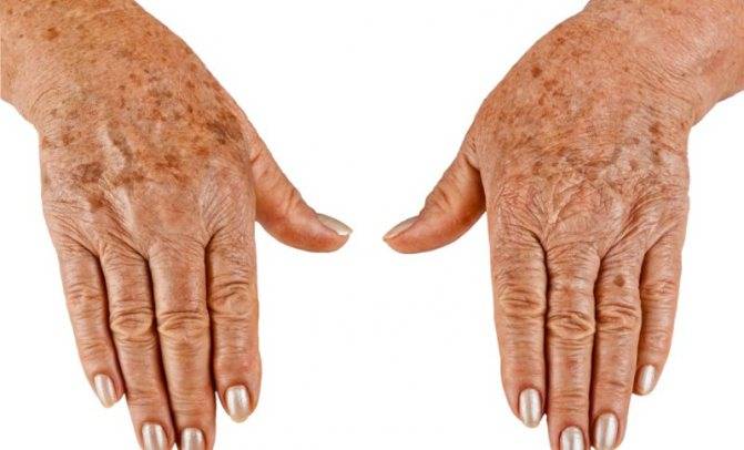 Как избавиться от возрастных (старческих) пигментных пятен на лице и руках? — журнал "рутвет"