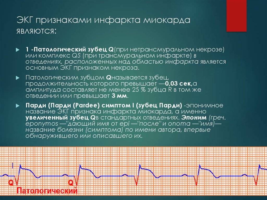 Экг при инфаркте миокарда: расшифровка, признаки инфаркта миокарда