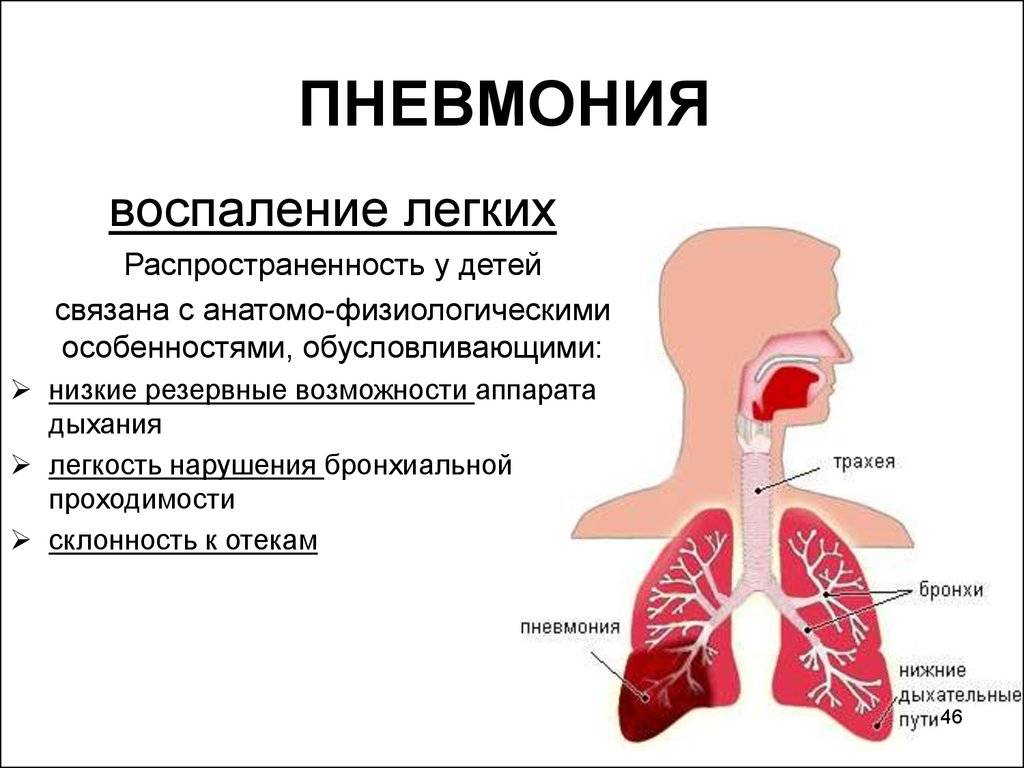 Двусторонняя пневмония: причины, симптомы, лечение