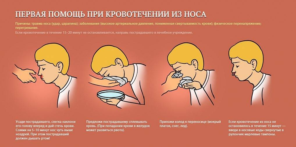 Как остановить кровь из носа в домашних условиях: у взрослого, у ребенка, средства