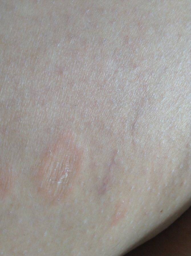 Сухая кожа тела: причины и методы лечения