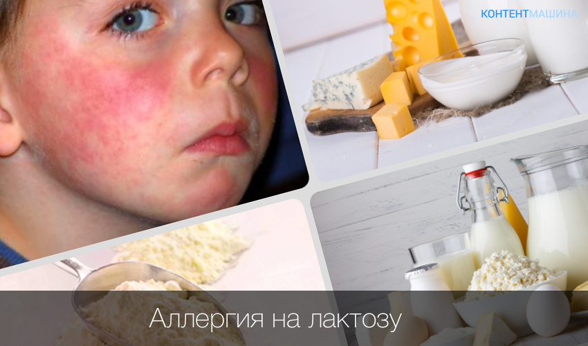 Аллергия на глютен: симптомы и лечение патологии у взрослых пациентов - о здоровье