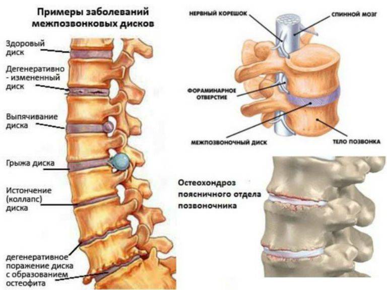 Гемангиолипома позвоночника поясничного отдела что это