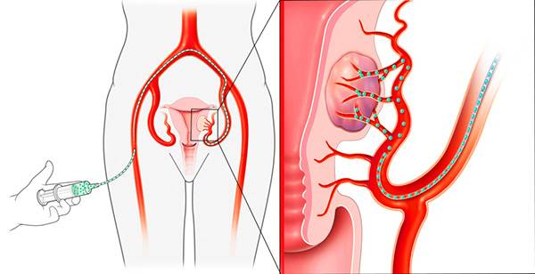 Метод эмболизации маточных артерий (эма)