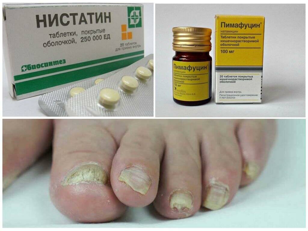 Как быстро вылечить грибок ногтей на ногах в домашних условия медикаментозными и народными средствами