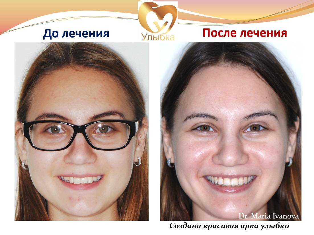 Как меняется лицо после брекетов? фото до и после
