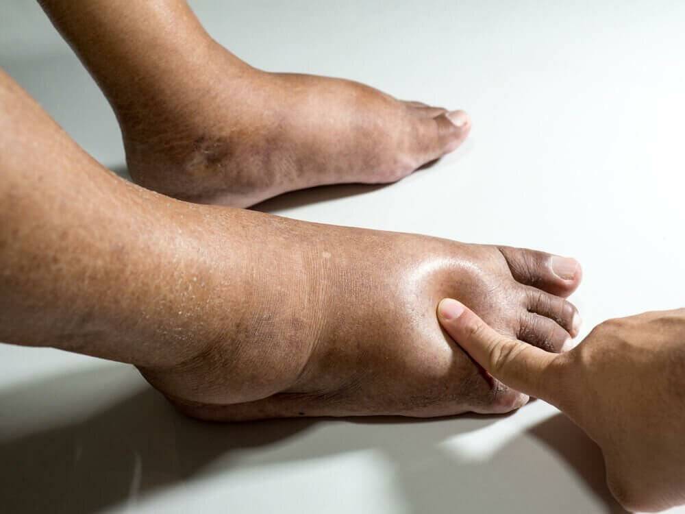 Гангрена при сахарном диабете на начальной стадии, лечение ног без ампутации (+фото)