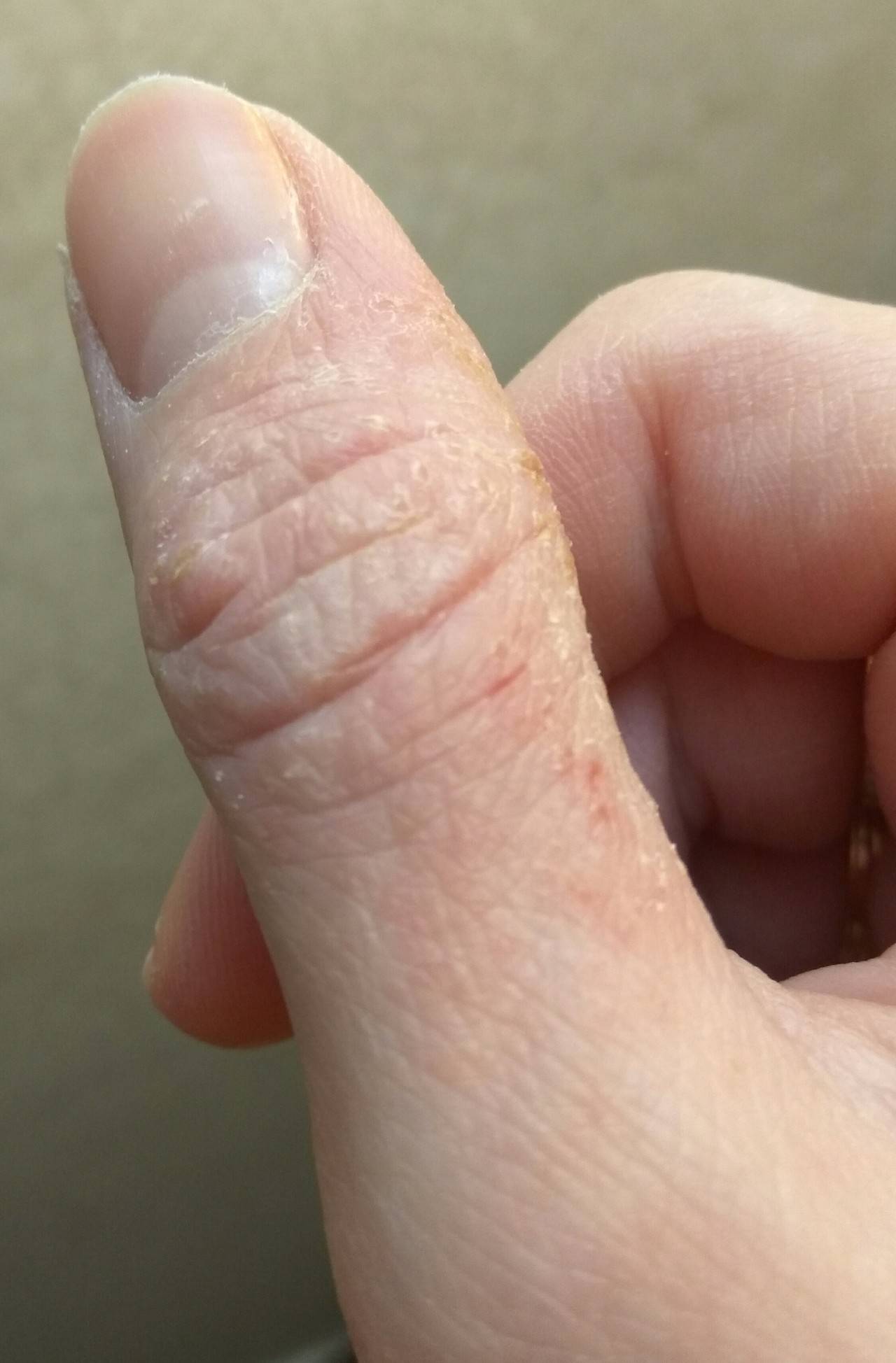 Покраснение между пальцами рук: фото, причины и лечение зуда и шелушения кожи | fr-dc.ru