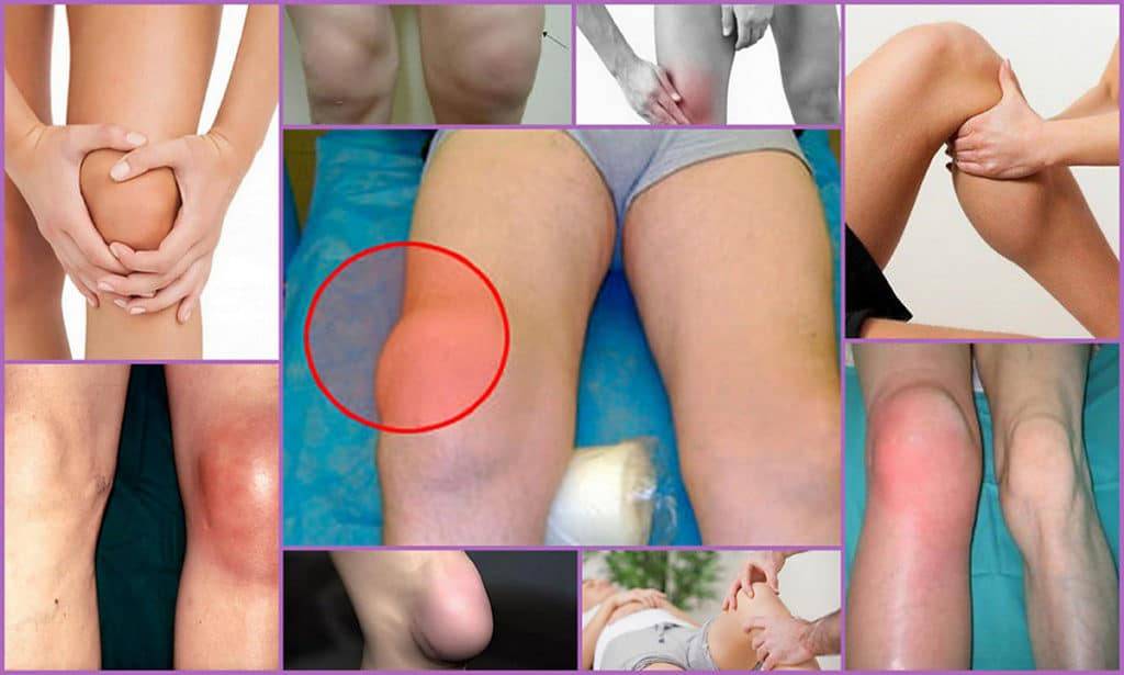 Супрапателлярный бурсит коленного сустава - эксперт по суставам