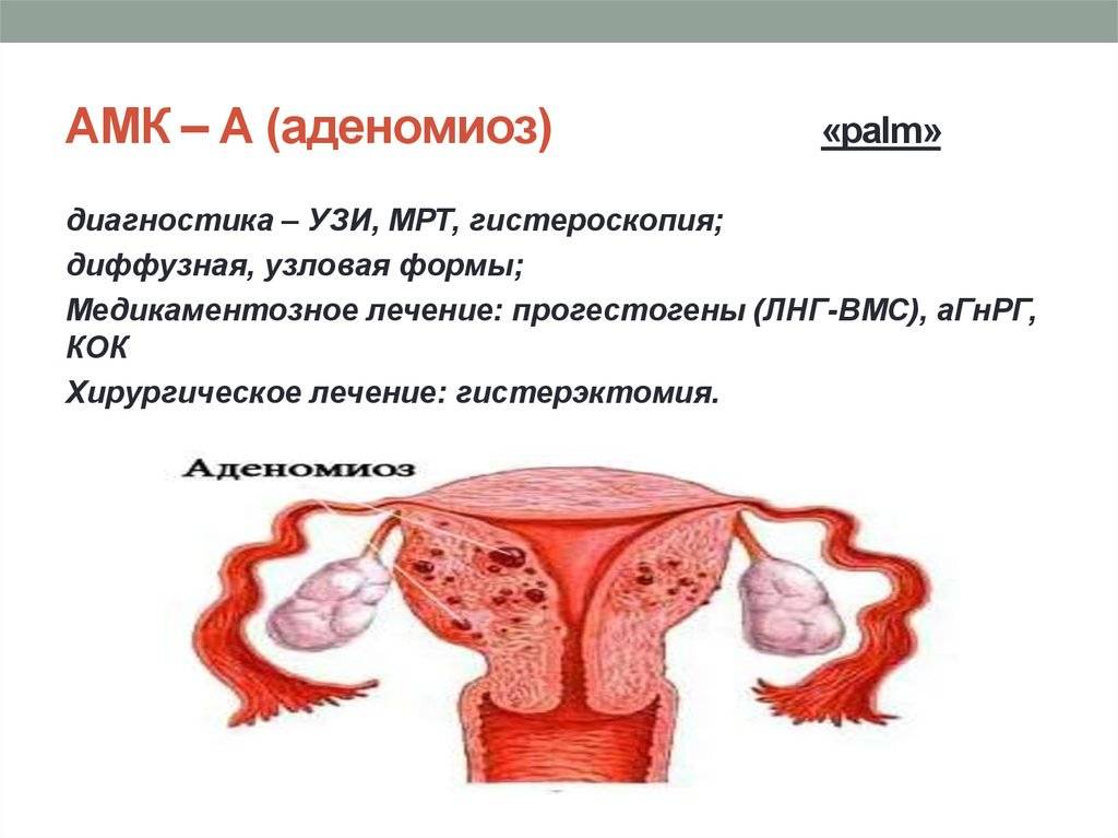 Симптомы и лечение эндометриоза матки народными средствами, препаратами в домашних условиях