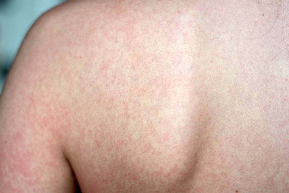 Противоаллергическая мазь от аллергии на коже и руках у взрослых