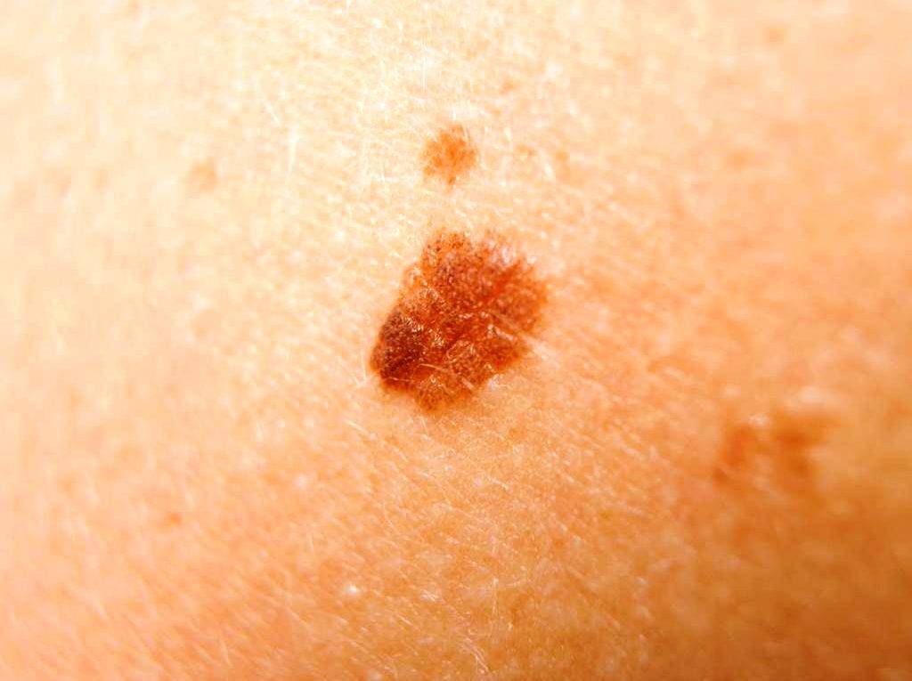 Пятна на коже шелушатся, но не чешутся: причины и лечение