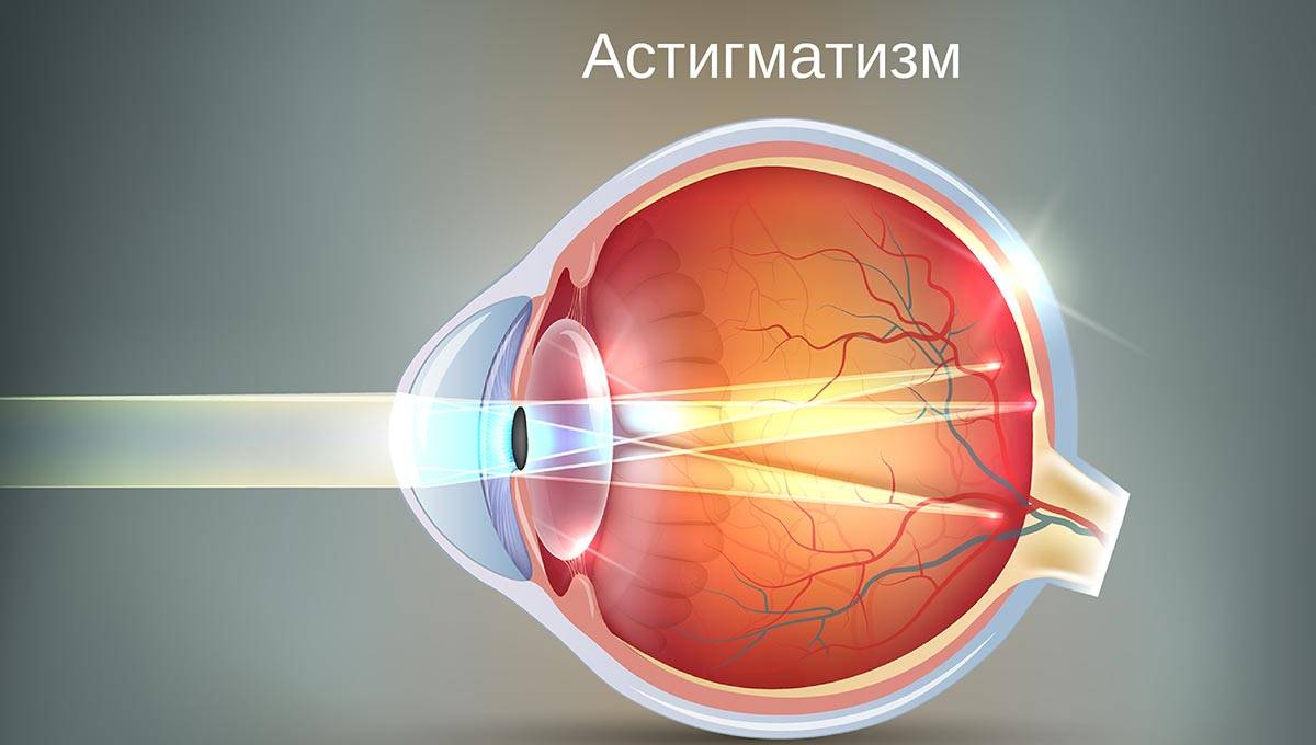 Проблема миопического астигматизма – как развивается и лечится патология зрения