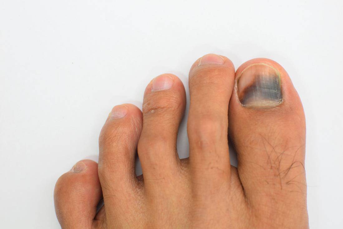 Чернеет ноготь на большом пальце ноги у женщин или мужчин - причины потемнения и пятен