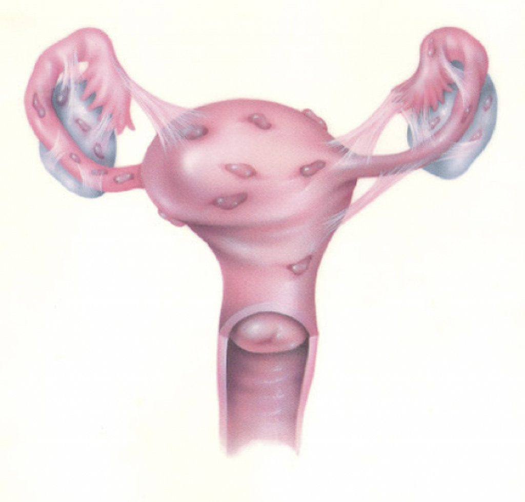 Симптомы и лечение эндометриоза матки при климаксе