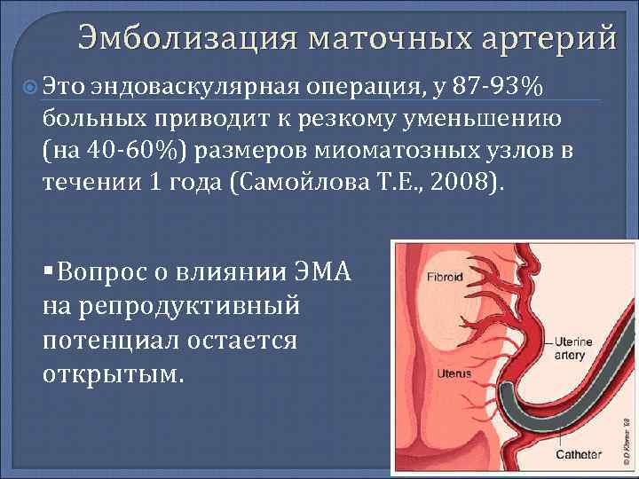 Эмболизация маточных артерий при миоме матки: отзывы, цена