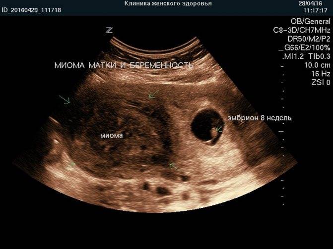 Что значит диагноз двурогая матка и возможно ли с этим забеременеть и родить