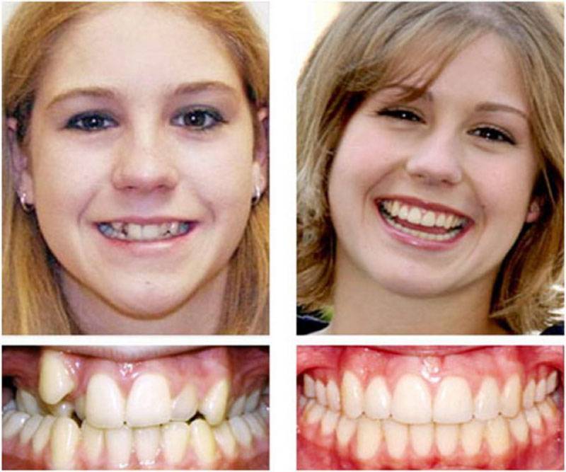 Со скольки лет можно ставить зуб. Неправильный прикус дистальный. Кривые зубы неправильный прикус.