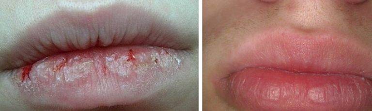 Трескаются губы: причины и лечение : labuda.blog
трескаются губы: причины и лечение — «лабуда» информационно-развлекательный интернет журнал
