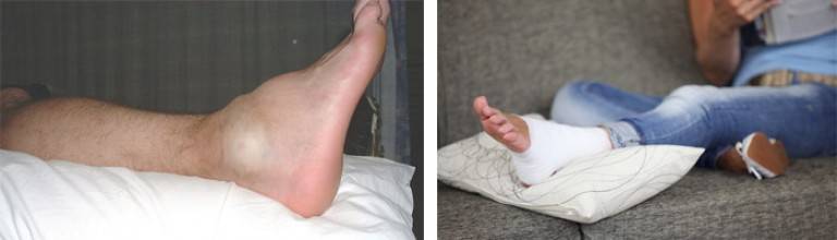 Перелом большого пальца ноги: симптомы. нужен ли гипс при переломе большого пальца ноги?