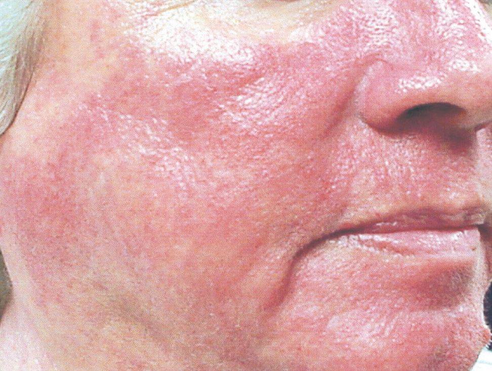 Красные щеки у взрослого. причины, почему горят, лечение, признаки болезни