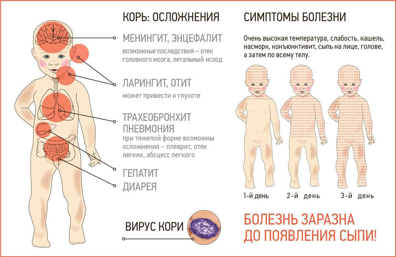 Корь у детей: симптомы и лечение, профилактика (фото)