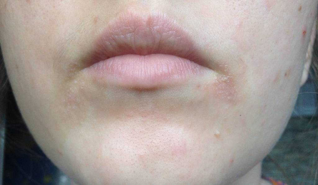 Покраснение вокруг рта, шелушение кожи у взрослого и ребенка: причины и лечение | fr-dc.ru