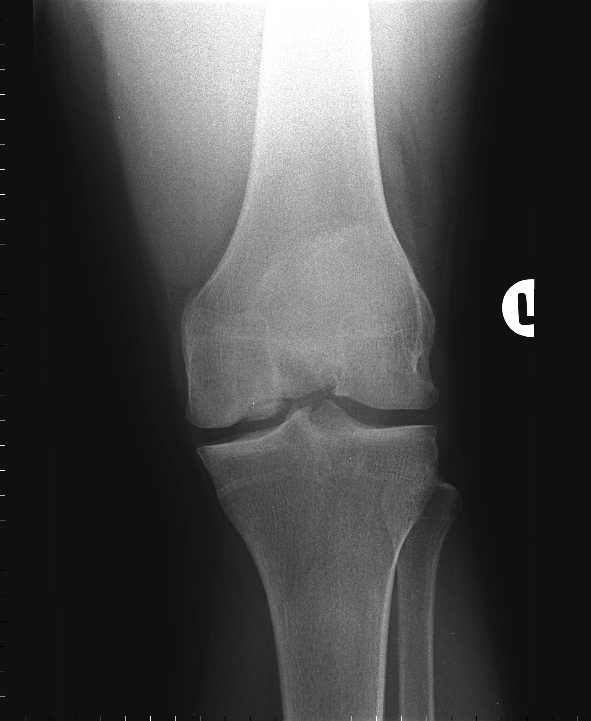Болезнь кенига коленного сустава: ее особенности