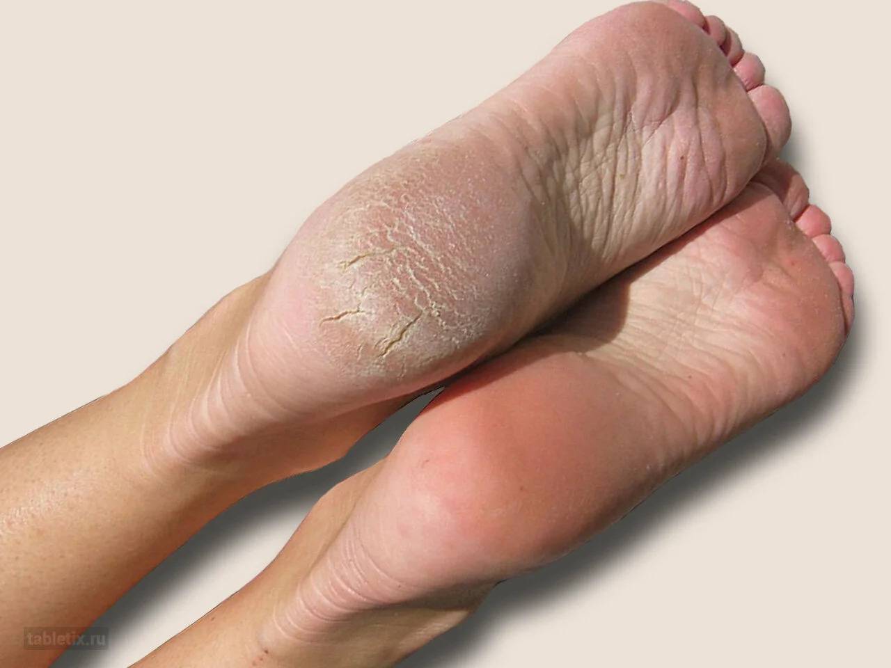 Почему шелушится и облазит кожа на ногах