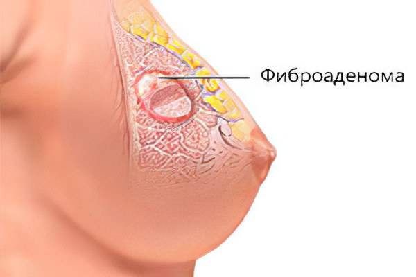 Листовидная фиброаденома молочной железы: симптомы и лечение опухоли | fr-dc.ru