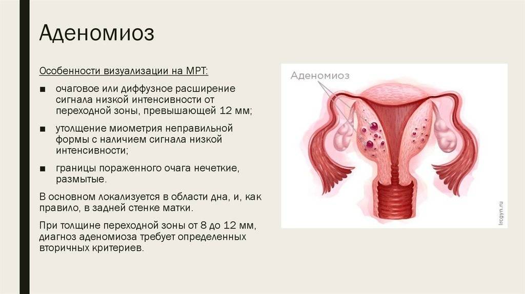 Новый многофакторный подход к лечению эндометриоза | iklumba