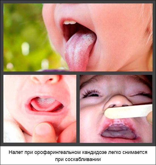 Кандидоз полости рта: симптомы, фото, лечение, последствия