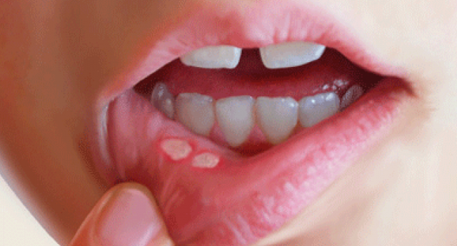Стоматит на языке у взрослых: причины, симптомы, лечение